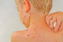 Vì sao nhiễm khuẩn đường huyết có thể gây tử vong