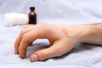 Mẹo điều trị, sơ cứu khi bị bỏng