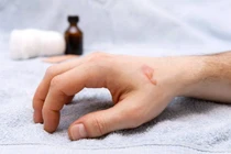 Mẹo điều trị, sơ cứu khi bị bỏng