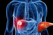 Nguy cơ ung thư gan từ thực phẩm giảm cân trôi nổi