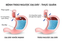 Trào ngược dạ dày có thể biến chứng thành ung thư thực quản
