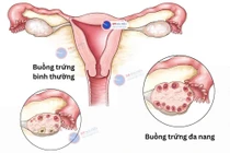 Đừng chủ quan với buồng trứng đa nang