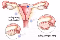 Đừng chủ quan với buồng trứng đa nang