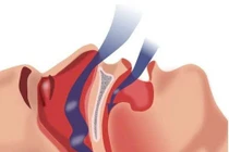 Ngưng thở khi ngủ ở nam giới, dấu hiệu ít được chú ý