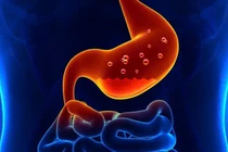 Thay đổi thói quen hàng ngày giúp kiểm soát axit dạ dày hiệu quả