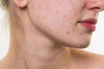 Hỏng da vì dùng mỹ phẩm không đúng cách