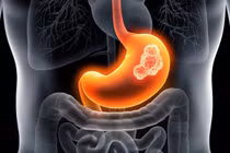 Cách nhận biết sớm ung thư dạ dày qua những dấu hiệu nhỏ