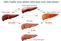 Cảnh báo bệnh lý gan nhiễm mỡ không do rượu ở người trẻ
