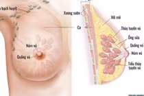 Ung thư vú ở phụ nữ trẻ tuổi, mối lo ngày càng tăng