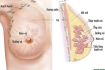 Ung thư vú ở phụ nữ trẻ tuổi, mối lo ngày càng tăng