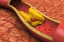 Nguy hiểm tiềm tàng từ mỡ trong máu cao, cách phòng tránh