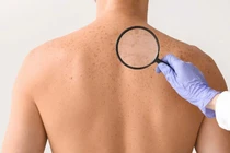 Phòng ung thư da, lão hóa sớm từ bên trong