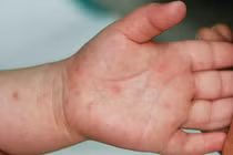 Phòng tránh bệnh tay chân miệng mùa cao điểm