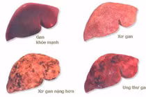 Ung thư gan gia tăng ở Việt Nam, thủ phạm từ thói quen ăn uống