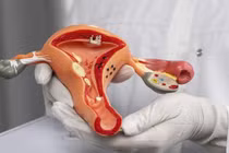 Nhận biết dấu hiệu ung thư cổ tử cung, cách phòng tránh