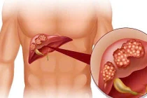 Nguy cơ viêm gan do uống thảo dược, thuốc nam không rõ nguồn gốc