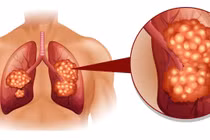 Ung thư phổi không do hút thuốc ngày càng gia tăng