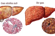 Gan nhiễm mỡ, căn bệnh âm thầm của thời hiện đại