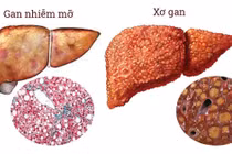 Gan nhiễm mỡ, căn bệnh âm thầm của thời hiện đại