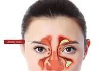 Biến chứng nguy hiểm của viêm xoang mạn tính