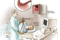 Khi nào nên nội soi tiêu hóa?