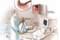 Khi nào nên nội soi tiêu hóa?