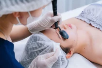 Tẩy nốt ruồi bằng laser, những điều cần biết để tránh sẹo