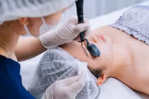 Tẩy nốt ruồi bằng laser, những điều cần biết để tránh sẹo