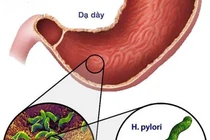 Vì sao vi khuẩn HP khó diệt, dễ tái phát?