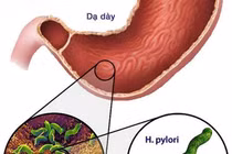 Vì sao vi khuẩn HP khó diệt, dễ tái phát?