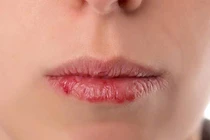 Làm gì khi môi luôn nứt nẻ, thâm sạm dù đã dưỡng?
