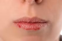 Làm gì khi môi luôn nứt nẻ, thâm sạm dù đã dưỡng?