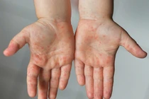 Phòng bệnh tay chân miệng hiệu quả cho trẻ