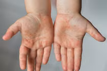 Phòng bệnh tay chân miệng hiệu quả cho trẻ