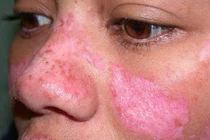 Dấu hiệu sớm của lupus, chớ chủ quan