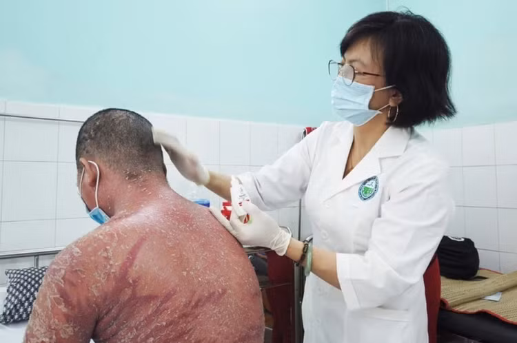 Bệnh nhân bị đỏ da toàn thân sau khi sử dụng thuốc trôi nỗi để điều trị vảy nến.