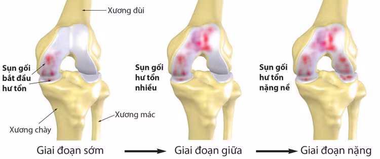 Rách sụn khớp gối ảnh hưởng lớn tới sức khỏe người bệnh. Rách sụn khớp gối ảnh hưởng lớn tới sức khỏe người bệnh.