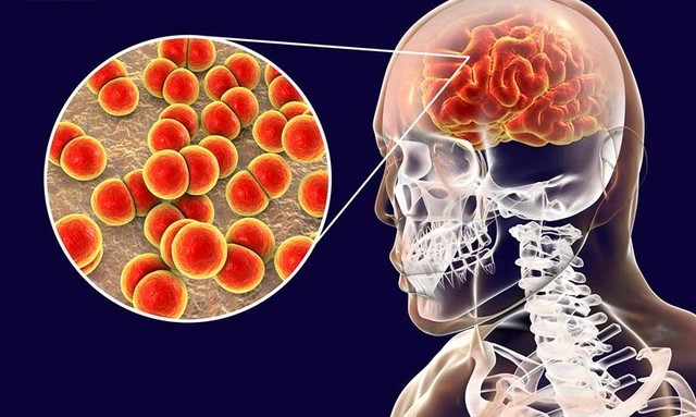 Viêm não, viêm màng não là những bệnh lý nhiễm trùng màng bao phủ não, nguyên nhân hầu hết bệnh là do virus gây ra, tỷ lệ biến chứng và tử vong cao.