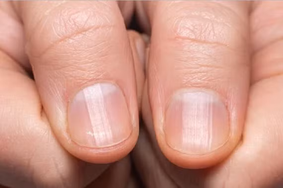 Dấu hiệu bất thường trên móng tay có thể liên quan nhiều bệnh