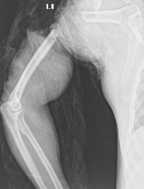 Cánh tay sau nối trên phim chụp - Ảnh BVCC