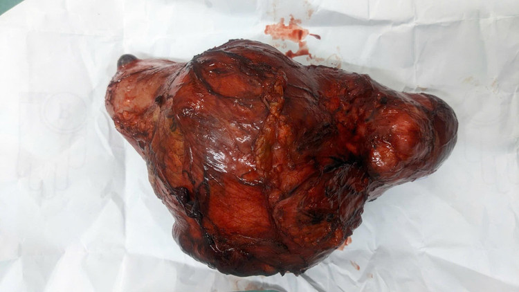 Khối u thận lớn được phẫu thuật cắt bỏ - Ảnh BVCC