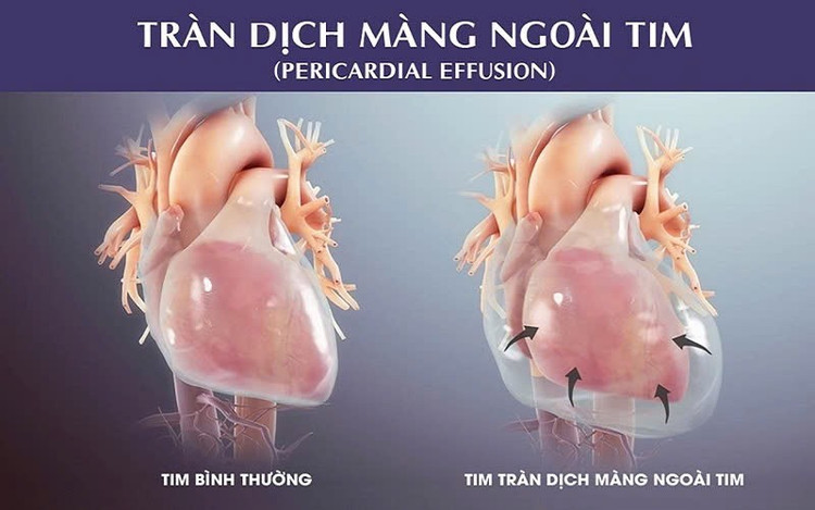 tran-dich-mang-ngoia-tim.jpg
