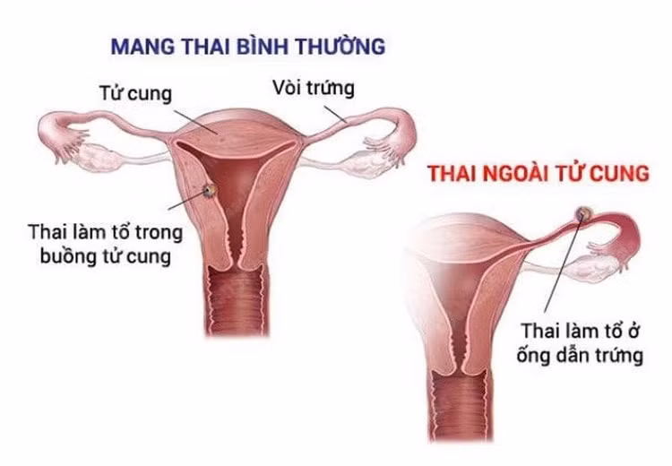 thai-ngoai-tu-cung.jpg
