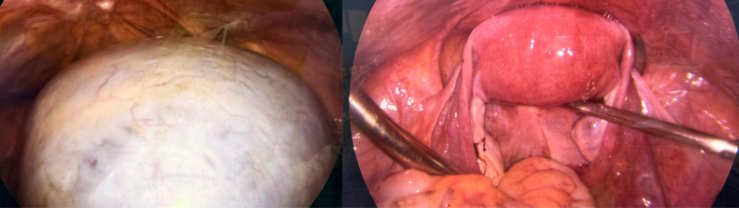Khối u buồng trứng khổng lồ - Ảnh BVCC