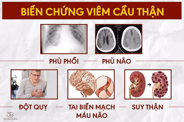 bien-chung-viem-cau-than.jpg