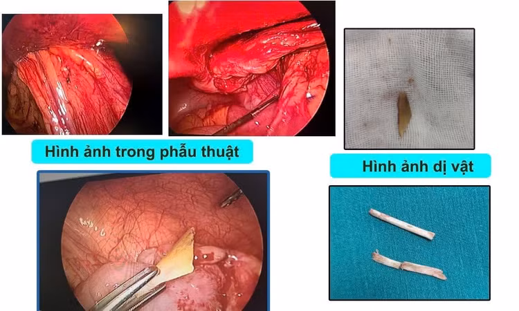 thung-ruot.jpg