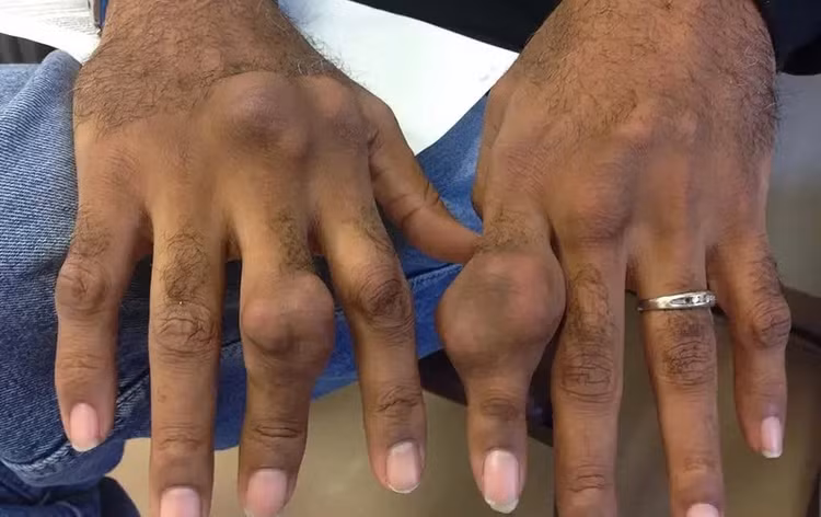 gout-1.jpg