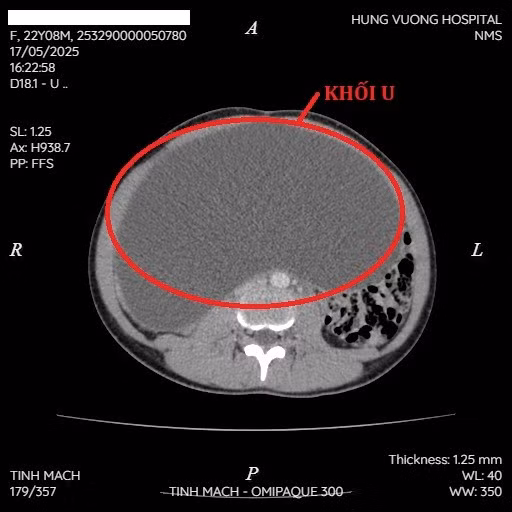 Khối u buồng trứng khổng lồ trên phim chụp - Ảnh BVCC