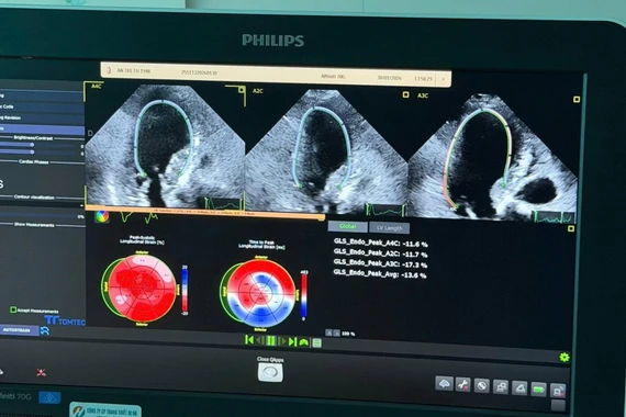 Siêu âm tim gắng sức, phát hiện sớm thiếu máu, tránh nhồi máu cơ tim