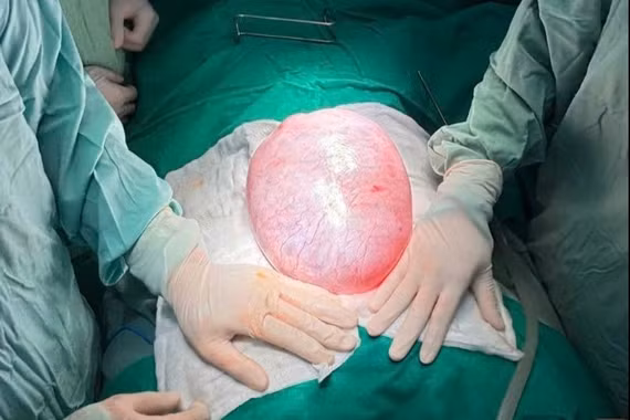 Con gái dậy thì bụng to dần, đi khám phát hiện khối u khổng lồ 4 kg